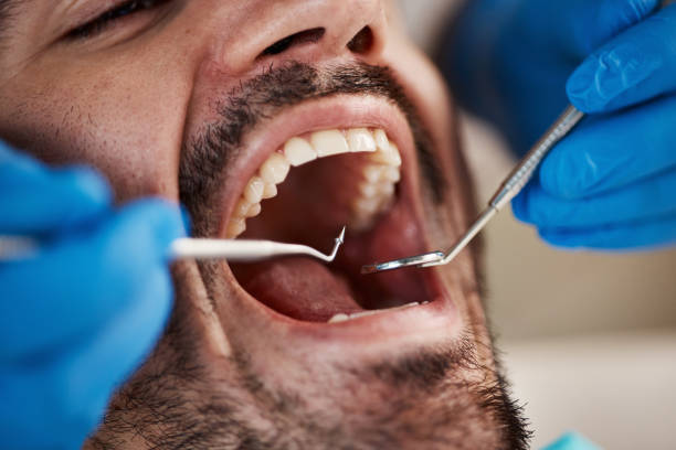 Dental Inlays and Onlays in Manchester, WA